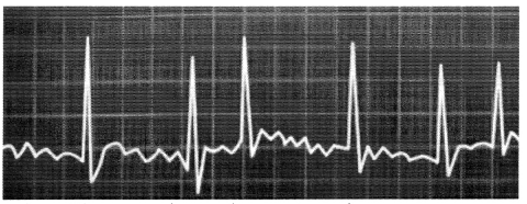 Cardiovascular System Circulatory Disorders NCLEX Questions with Rationale 2