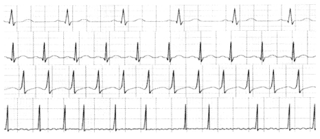 Cardiovascular System Circulatory Disorders NCLEX Questions with Rationale 3