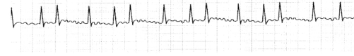 Cardiovascular System Circulatory Disorders NCLEX Questions with Rationale 4