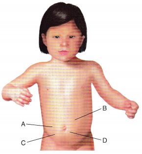 Child with Gastrointestinal Tract Health Problems NCLEX Questions with Rationale 3