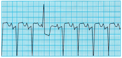 Cardiac Health Problems NCLEX Questions with Rationale 2