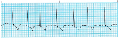 Cardiac Health Problems NCLEX Questions with Rationale 8