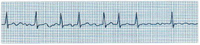 Cardiac Health Problems NCLEX Questions with Rationale 9