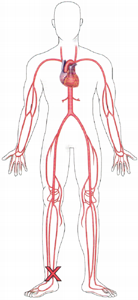 Vascular Disease NCLEX Questions with Rationale 4