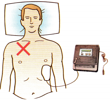 Emergency and Disaster Nursing NCLEX Questions with Rationale 2