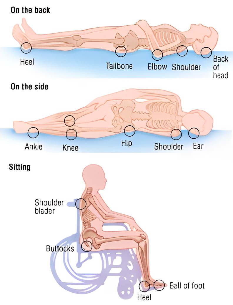 Pressure Ulcer