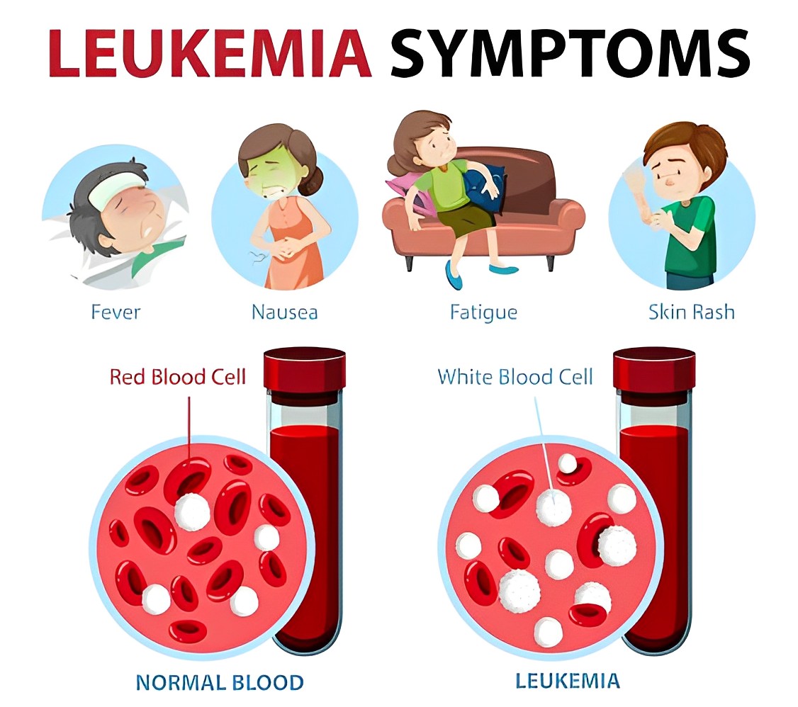 Leukemia symptoms