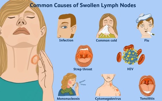 10 Home Remedies To Treat Swollen Lymph Nodes Naturally ...