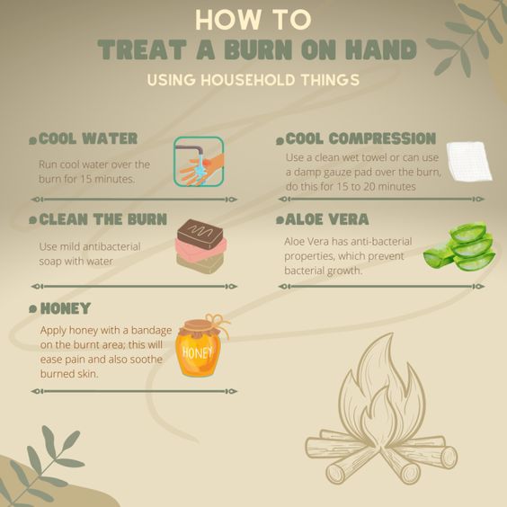How to Treat a Burn on Hand