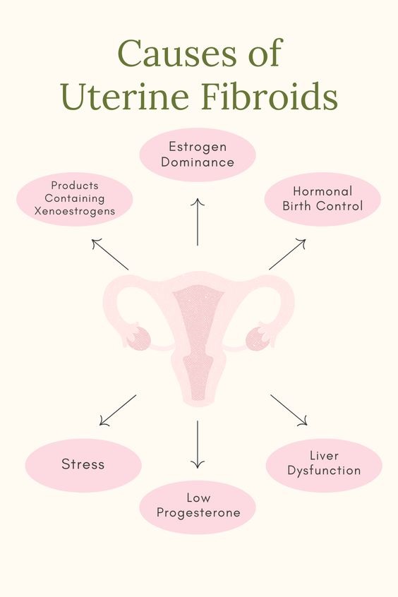 Causes of Uterine Fibroids