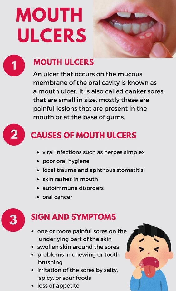 10 Natural Remedies For Mouth Ulcers: Heal That Sore Spot At Home ...