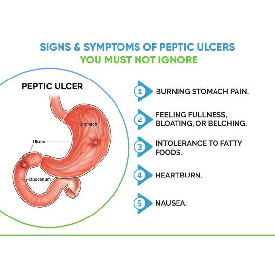 Signs & Symptoms Of Peptic Ulcers