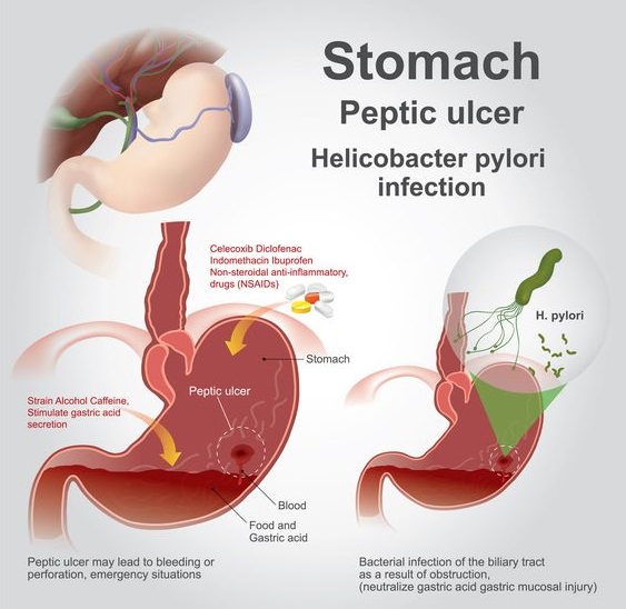 Stomach peptic ulcer chart