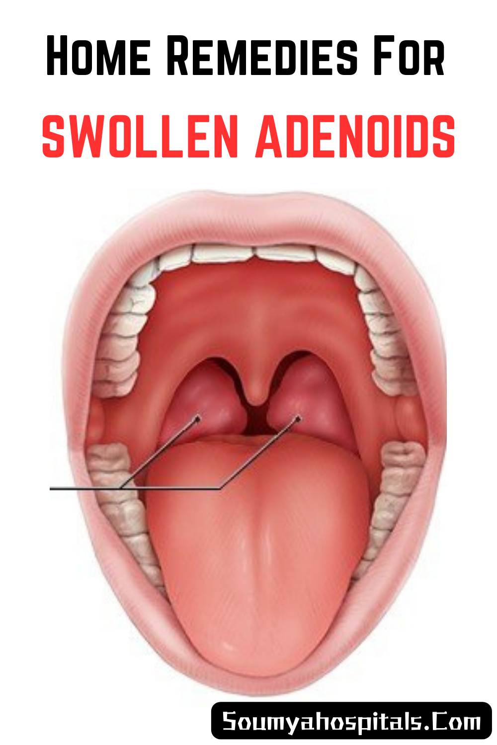 Home Remedies For Swollen Adenoids 