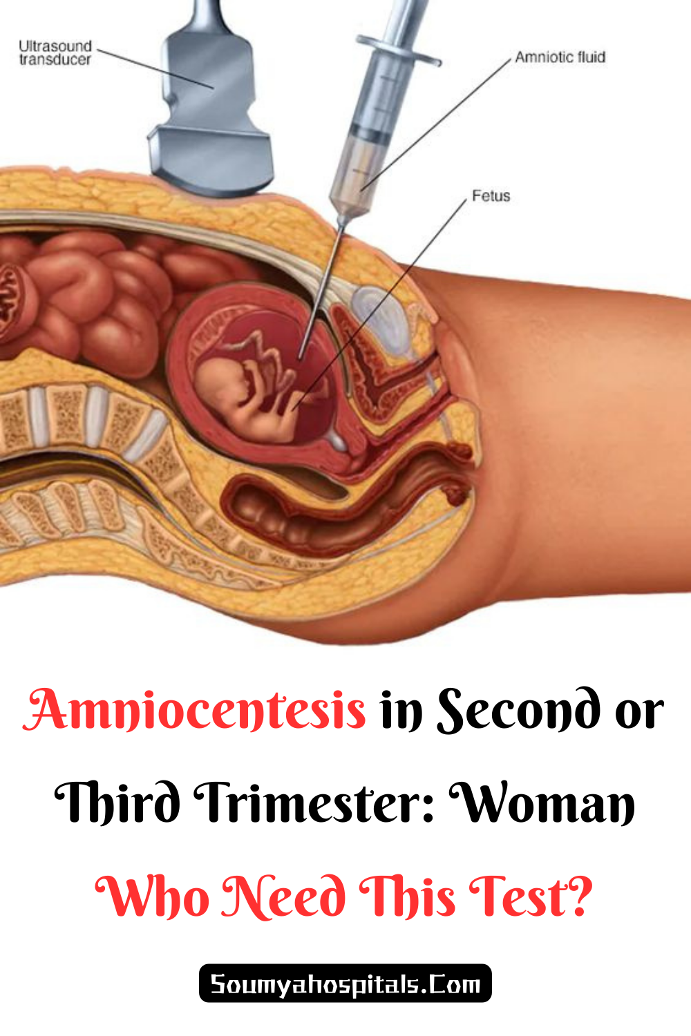 Amniocentesis in Second or Third Trimester: Woman Who Need This Test?
