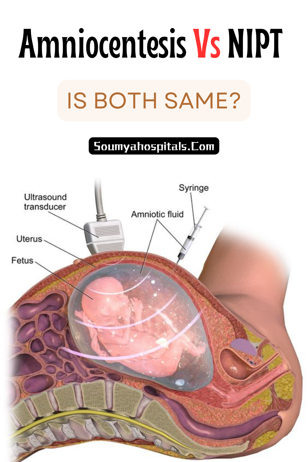Amniocentesis Vs NIPT - Is Both Same