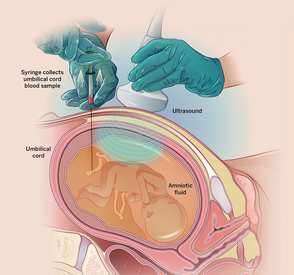 Detailed Process of Prenatal Percutaneous Umbilical Blood Sampling Test