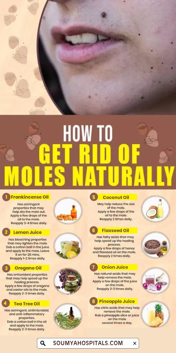 Natural Remedies for Mole Removal