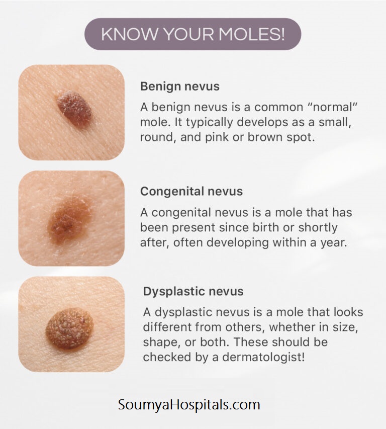 Types Of Moles
