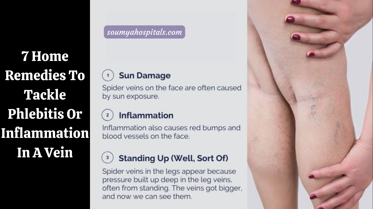 7 Home Remedies To Tackle Phlebitis Or Inflammation In A Vein