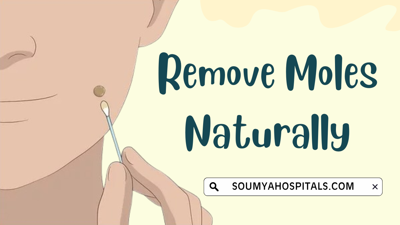 Most_Effective_Natural_Remedies_for_Mole_Removal